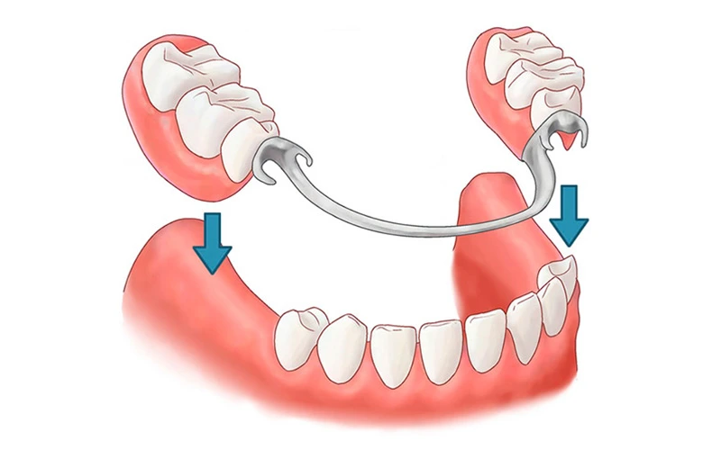 estetica dental protesis parcial en Las Rozas Clinica Dentall