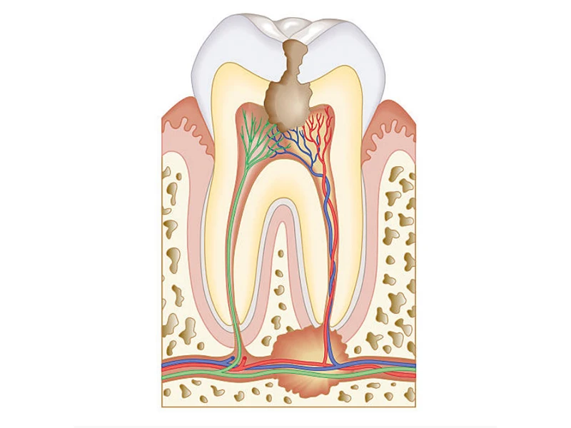 odontologia general endodoncia tratamiento Clinica Dentall en Las Rozas